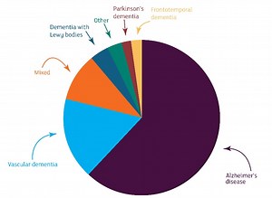 Dementia with Lewy bodies explained - Alzheimer's Research UK