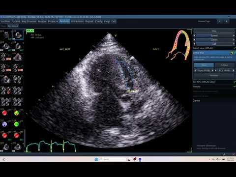 IQ 706 RVEF RVGLS RVTTP RVPSI ECHOCARDIOGRAPHY PROCEDURE