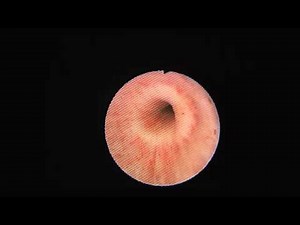 Artificial Urinary Sphincter Closing • Video • MEDtube.net