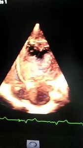 Left Ventricular Non-Compaction Cardiomyopathy