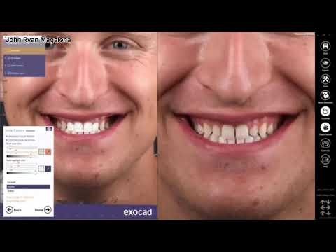 Cad Cam and Smile Design Digital Dentistry