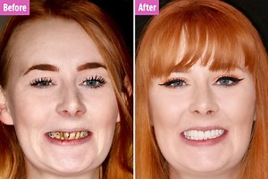 Woman, 26, who faced wearing dentures transforms her rotten teeth with braces