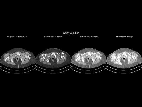 Image-to-Image AI for CT Enhancement