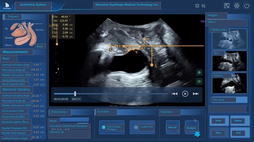 Deep learning–assisted two-dimensional transperineal ultrasound for analyzing bladder neck motion in women with stress urinary incontinence - Examples of automatic measurement during TPUS using the AutoPelvic system. 1, a TPUS of the control group; 2, a TPUS of the SUI group https://ow.ly/NI4h50UzUhY | American Journal of Obstetrics & Gynecology