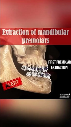 EXTRACTION OF MANDIBULAR PREMOLARS - ORTHODONTIC TIPS #Shorts