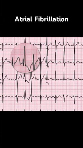 Atrial Fibrillation ECG: Ashman phenomenon