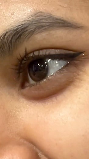 60K views · 740 reactions | Her Sparkling Eyes & Cheeks full of small mosquito bites 路‍♀️ #reelkarofeelkaro #reelitfeelit #sumo | Sumaiya Parvin | Facebook