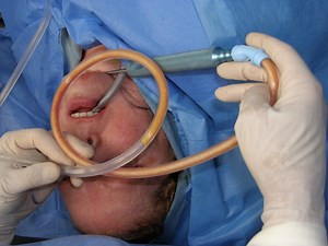 Face Liposuction Richmond VA | Facial Liposuction | Neck Liposuction