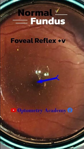 Normal fundus | Normal Retina | Smartphone Fundus Videography | Fundus Photography | Short Video 477