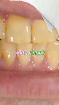 Whiten Your Teeth Naturally with Banana Peels – Does It Really Work?