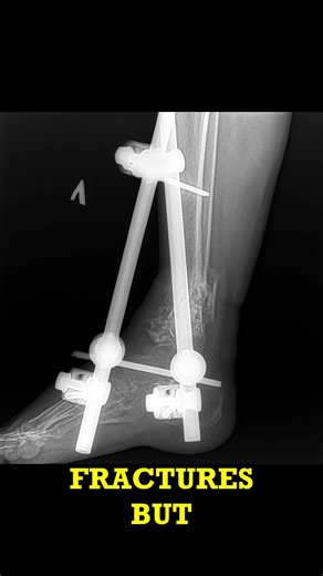 Healing Ankle Fracture X-Ray Quick Rads #shorts