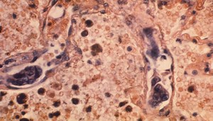 U.S. cancer death rate sees another record decline but remains No. 2 cause of death