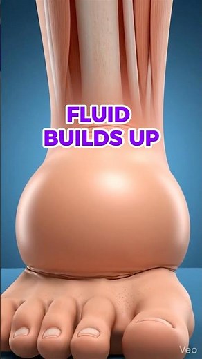 What Happens When Fluid Builds Up in Your Body #bloodflowhealth #science #lymphatic