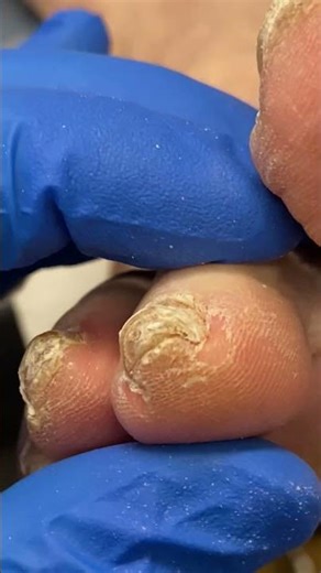 Extreme Callus Removal on Toe by Podiatrist! #FootCare #Satisfying #CallusRemoval