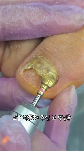 #발톱무좀 #발톱스케일링 ➡️네이버에 ♡ 구리손끝향기 ♡검색하세요📍구리시 수택동 449-21 1층 손끝향기📞031.567.3023 ( 상담시간; 오전 11시~오후6시까지 )