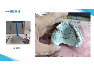 3shape活动支架设计总体步骤简介