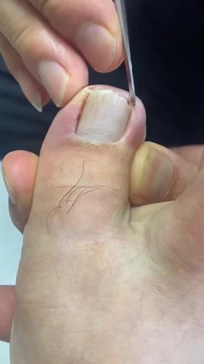 Ingrown toenail removal #fypシ #fyp #ingrowntoenail #pedicure #foryou