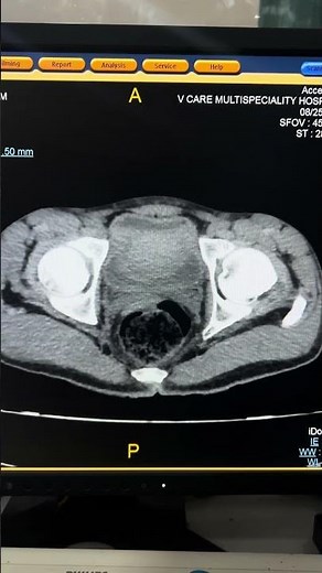 Hemoperitoneum in CECT Abdomen | CT Trauma