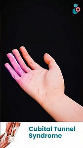 Cubital Tunnel Syndrome | 3D Medical Animations #NerveCompression #CubitalTunnelSyndrome