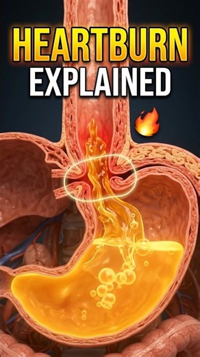 Acid Reflux Explained: Why Heartburn Happens
