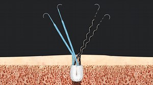 Patellar Tendon Repair With Semitendinosus Augmentation Using Knee FiberTak® Anchors