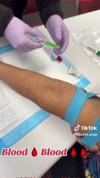 Venipuncture using Butterfly Needle 💉🩸🧪🩸🌡️👩🏻‍🔬🫶🏼 #phlebotomy #phlebotomist #phlebotomystudent #laboratory #lab #drawingblood #blooddraw #butterflyneedle #blood #venipuncture #nurselife #nursesoftiktok #usa #nurse #rn #viral #fypシ #fyp #usa_tiktok
