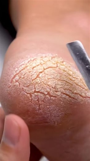 Foot Cleaning ASMR | Soft Scraping Relaxation IM8T #footcare #heeleexfoliation #pedicure #oddlysatisfying #dryskinremoval Enjoy clean, relaxing foot-care ASMR with gentle heel exfoliation and natural callus removal. Disclaimer: AI-generated educational & relaxation content. | Soul Walker