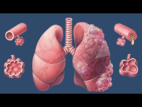 Bronchopneumonia: Causes And Symptoms