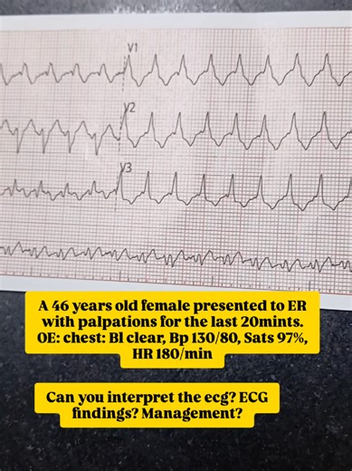 ECG Quiz ! what rhythm is it? can you interpret the ecg? #cardiologia #cardiology #ekg #nurse #ecg