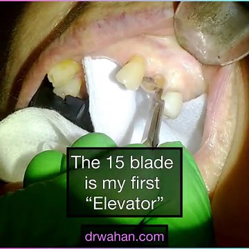 Simple Premolar Extraction Using the 15 Blade as my First Elevator