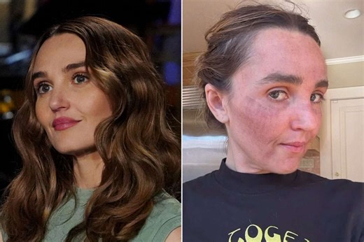 'SNL' star Chloe Fineman posts photo gallery of her 'botched' med spa procedures