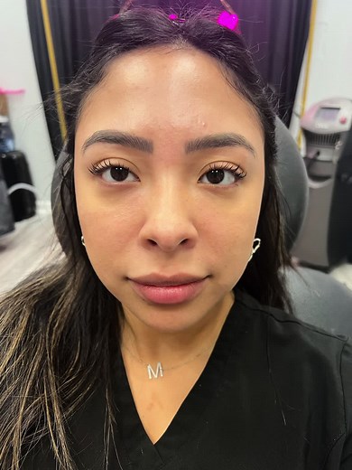 Cheek pop with Restylane Contour #cheek #cheeks #contour #contouring #filler #botox #injections #face #esthetician #medical #spa #texas #houston