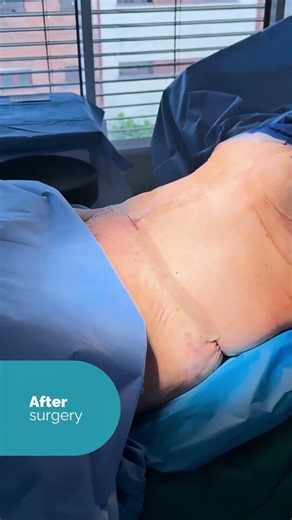🎥 Straight from the operating room: 360 FDL tummy tuck combined with waist liposuction