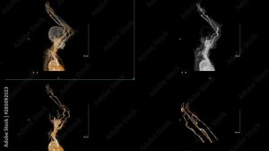 Multi VIEW of CTA brachial artery or CT scan of upper extremity 3d rendering image for diagnosis brachial artery stenosis .