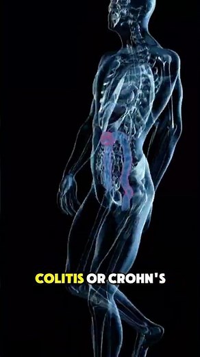 Colectomy, Removal of Colon Procedure – Symptoms #3danimation #symptoms #colon #disease #healthcare