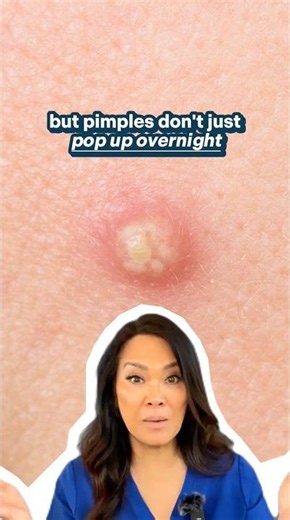 How pimples REALLY form (and how to prevent them from popping up) 🙅🏻‍♀️⁠#drpimplepopper #pimple