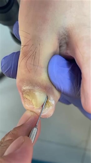 Easy and simple tips for cleaning and treating infected ingrown toenails. #nailsonfleek #explorepage #nail #gelnails #inspire #nailstagram #nailart | Ellen Morris