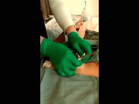 My Hickman line Removal