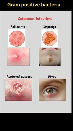 Infections caused by Staphylococcus aureus -Gram positive Cocci in clusters #infection #quickreview