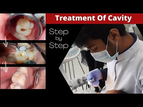 Composite Filling (Step by Step) || Cavity In Tooth || How To Fill Decayed Tooth || Dr. Sunil Kumar