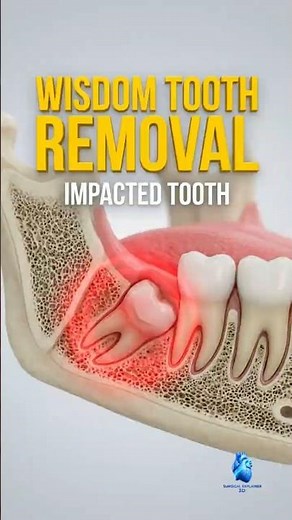 Wisdom Tooth Extraction Explained | Realistic 3D Dental Animation #dentist #wisdomtoothextraction