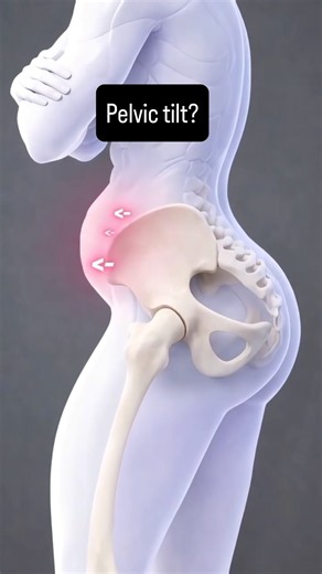 Suffering from pelvic tilt? Try these powerful yoga poses. #yogaforwoman #happyyoga #fyp