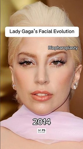 Lady Gaga's beauty evolution✨ #millennialplasticsurgery