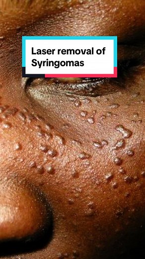 Laser Removal of Syringomas at Derma Skin Clinic in Kampala