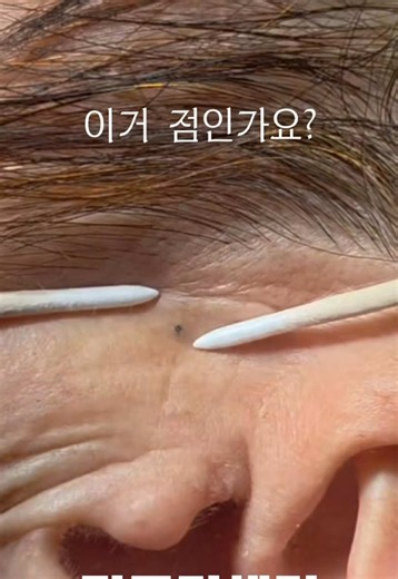이거 점인가요? #50대피부관리 #40대피부관리 #비립종#좁쌀여드름#원주슈퍼젝션