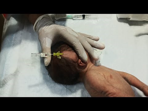 Scalp IV Cannulation in Septic Newborn | Safe Technique & Infection Control