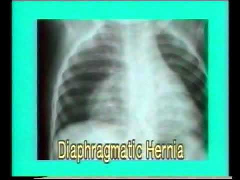 3.8. Diaphragmatic Hernia and Eventration - Chest X-Rays - Dr. Vaidya