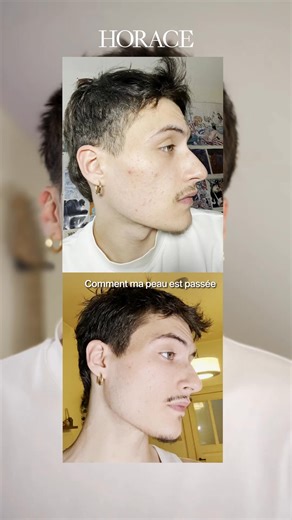 548K views | Notre Sérum Anti-Imperfections est back in stock ! Faites le plein et débarrassez vous des boutons ! | Horace | Facebook