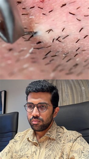 Watch This Hair Come Free