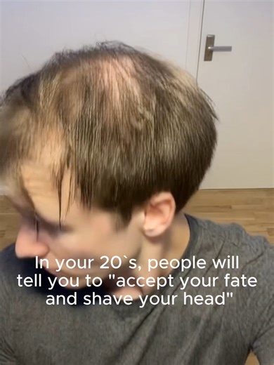 Effective Hair Loss Treatments for Men